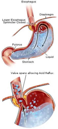 Acid reflux - can be due to too little stomach acid!
