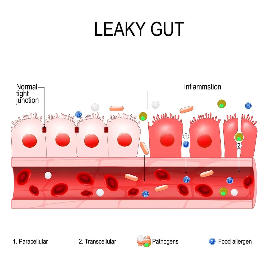 Leaky Gut, It Really Is a Thing!