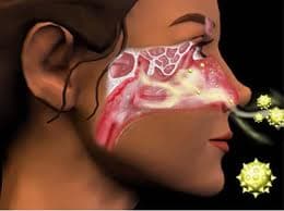 Natural Help for Hayfever Sufferers
